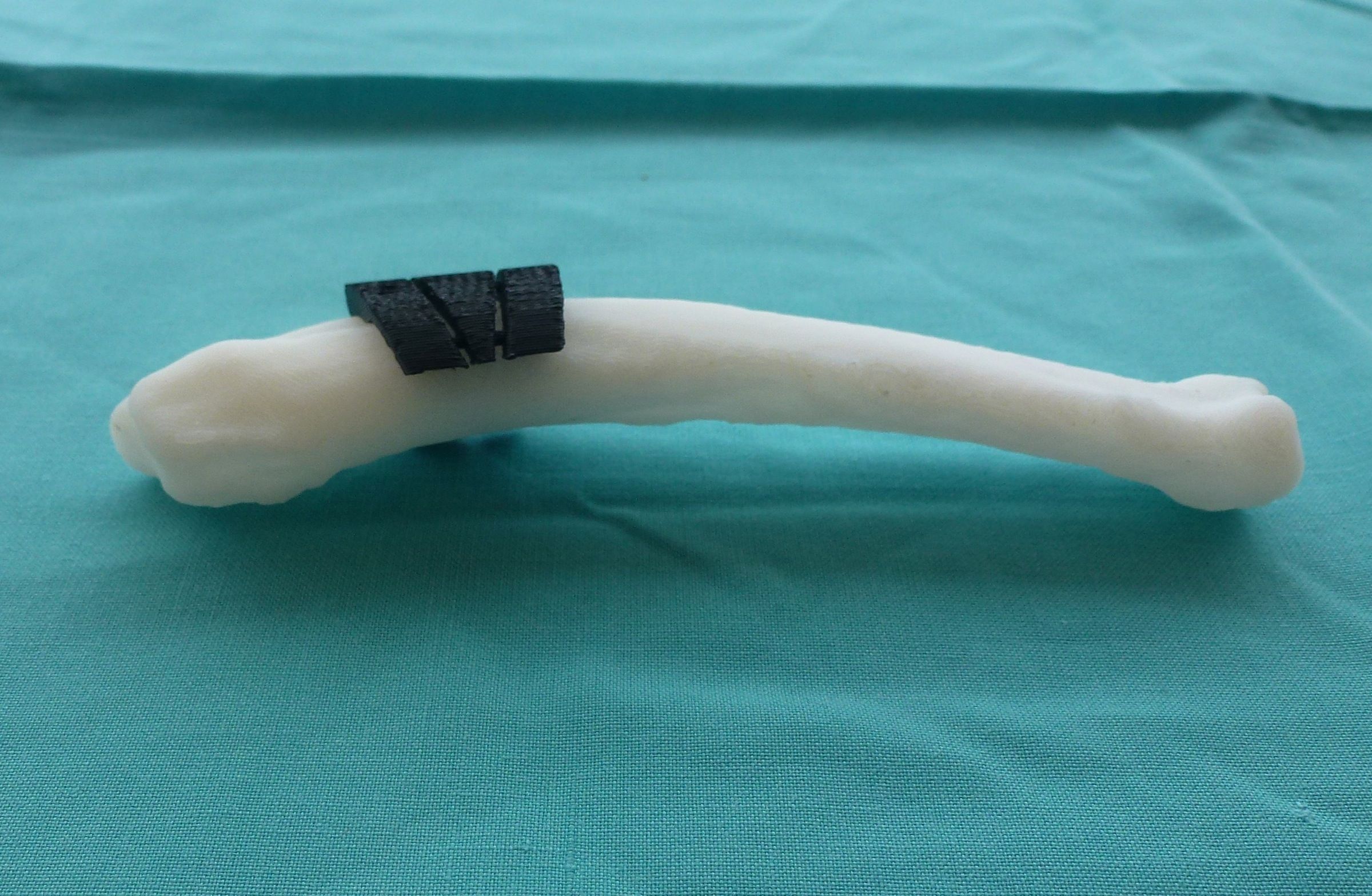 El dispositivo guía patentado por la CEU-UCH marca el ángulo de corte óptimo y los puntos de fijación de la prótesis para realinear el hueso desviado.