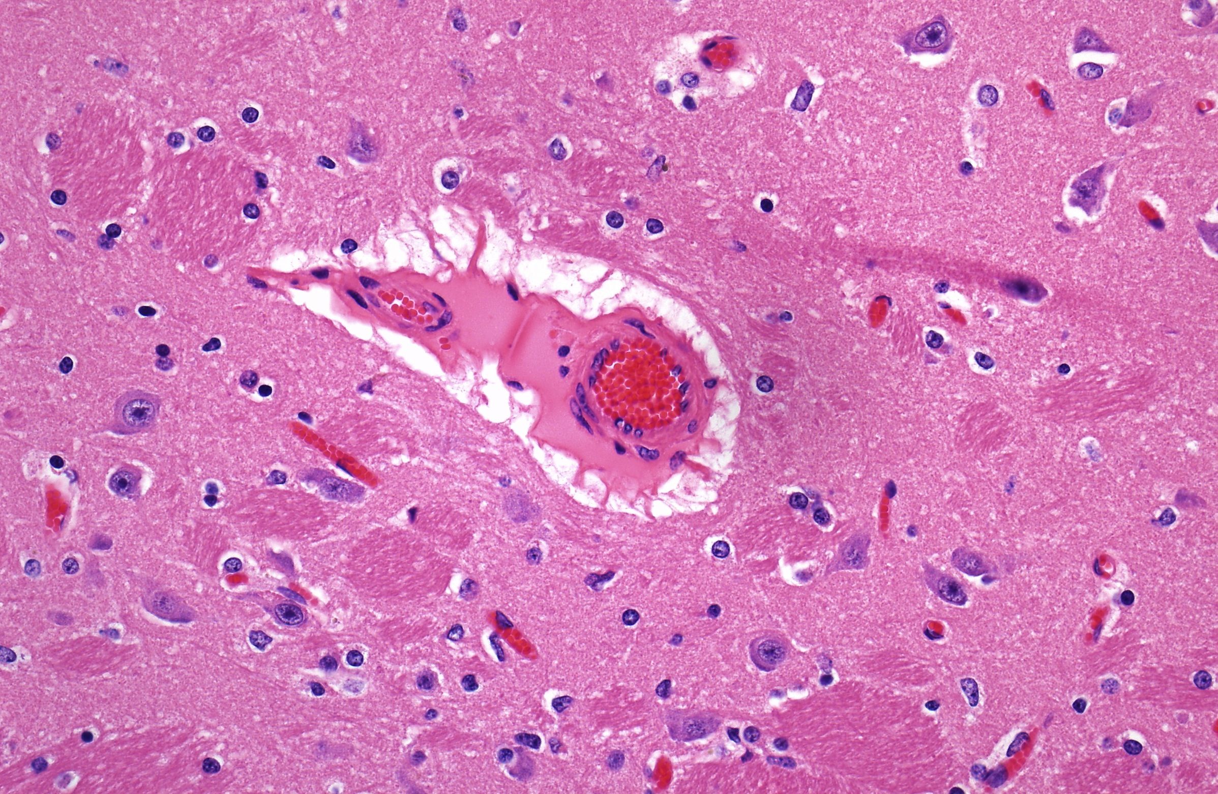 Imagen histológica que muestra el edema perivascular observado en el encéfalo de los animales del estudio del profesor Ortega en UC Davis.